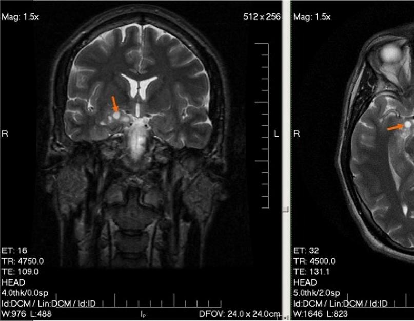 Объемный процесс головного мозга мкб 10. Опухоли головного мозга - описание, симптомы (признаки), диагностика, лечение. Что такое менингиома