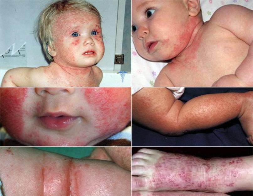 Атопический дерматит у детей этиология патогенез клиника. Атопический дерматит: этиология и патогенез. Обязательные лабораторные исследования