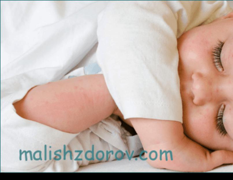 Сыпь на переносице у ребенка причины. Мелкая сыпь на лбу у ребенка. Дифференциальная диагностика сыпи инфекционного происхождения