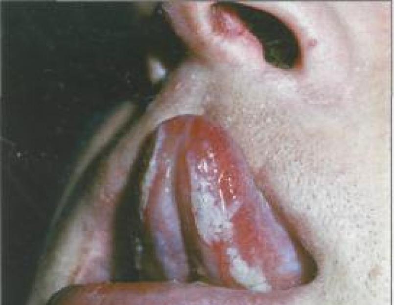 Аллергия во рту и вокруг него: признаки, симптомы и лечение. Аллергия во рту признаки Аллергические поражения слизистой оболочки полости рта